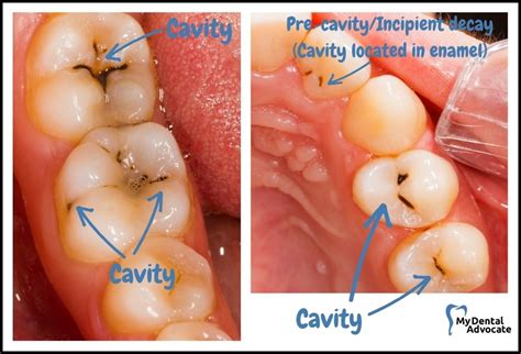 what does a cavity look like.